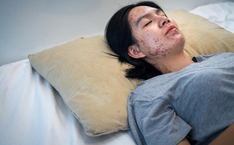 First US measles deaths of 2026 reported amid row over MMR vaccine