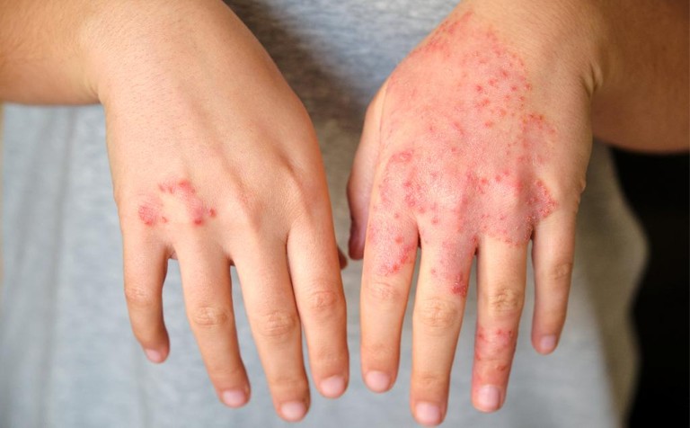 Mpox Continues to Spread as Health Agencies Track Outbreaks Across Regions