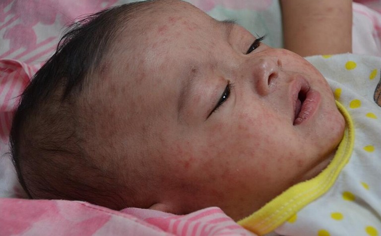 More than 1,100 deaths reported as Bangladesh battles devastating measles outbreak